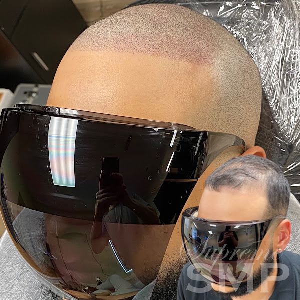 Bryan andover scalp micropigmentation: supreme smp Bryan andover scalp micropigmentation: supreme smp