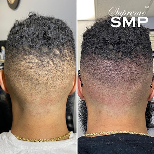 John scalp micropigmentation concord: supreme smp