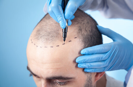 Hair tattoo or hair transplant: supreme smp