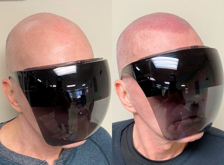 What smp actually does to a receding hairline e1782115553600: supreme smp