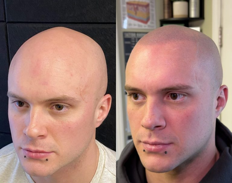 What scalp micropigmentation actually costs scaled e1783415773419: supreme smp