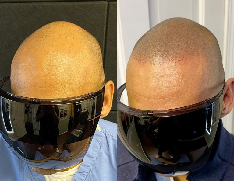 What the shaved head smp result actually looks like scaled e1783415673287: supreme smp
